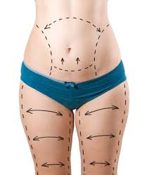 May 17, 2019 · a panniculectomy is more expensive than a tummy tuck, but it's often covered by medical insurance. How Does A Tummy Tuck Differ From A Belt Lipectomy Dr Al Cohn