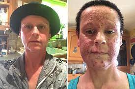 Food allergies rarely affect the hair, because they usually appear on the skin (not on the scalp). Woman Suffers Horrendous Allergic Reaction To Garnier Hair Dye That Left Her Face Covered In Weeping And Painful Sores