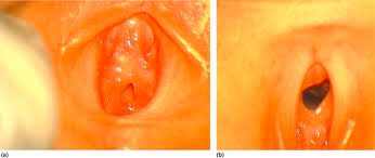 Imperforate hymen diagnosed beyond the newborn period may present a dilemma for the physician. Hymen An Overview Sciencedirect Topics