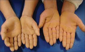 Cele 5 tipuri de boala. Diagnosticul DiferenÈial In Keratodermiile Palmo Plantare Health Beauty Online Journal