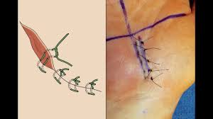 The advantages of the vertical mattress suture are that it provides closure for both deep and superficial layers, and also allows perfect eversion and vertical opposition of the superficial skin edges. Live Surgery What Is Horizontal Mattress Suturing Of The Skin How To Horizontal Mattress Suture Youtube