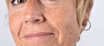 Ungeeignet sind retinoide für schwangere und stillende frauen. Naturliche Helfer Gegen Altersflecken Diese Sollten Sie Kennen