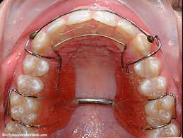 La dre tu anh vu est une dentiste agréée qui dirige son cabinet privé tu's dental, situé à brooklyn, new york. Solutions Aux Dents Qui Se Chevauchent Dr Sylvain Chamberland
