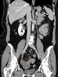 Mayo clinic, endometriosis. radiology, endometrial cysts: Cureus Endometriosis Of The Vermiform Appendix Presenting As Acute Appendicitis