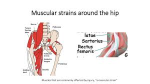 The hip muscles encompass many muscles of the hip and thigh whose main function is to act on the thigh at the hip joint and stabilize the pelvis. Muscle Strains Around The Hip And Pelvis Joint Recon