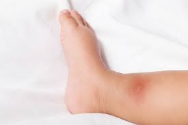 Find bed bug bites treatment. Ehikzovsv1dham