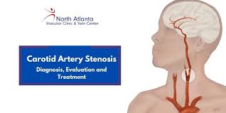 Image result for carotid artery