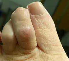 Maybe you would like to learn more about one of these? Hammer Toe Orthoinfo Aaos