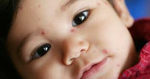 Trẻ nổi mụn, cha mẹ chớ lo!