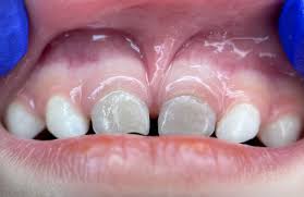 Image result for Tooth Discoloration