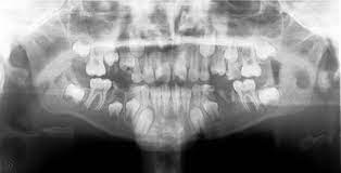 Dental Management Of Patient With Von Willebrand Disease