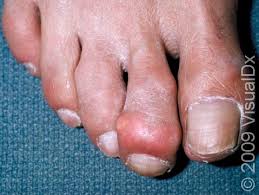 Image result for gout symptoms toe