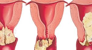 Disebabkan perkara tersebut, ramai dikalangan mereka yang menghidap penyakit ini tidak dapat bertahan lama kerana. Wanita Wajib Tahu Tanda Kanser Rahim Bila Keputihan Berwarna Coklat Bercampur Darah Infoje Org