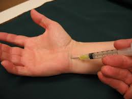 Este nervio pasa por la parte interior del brazo y traspasa hacia adelante del codo. Sindrome Del Tunel Carpiano Carpal Tunnel Syndrome Orthoinfo Aaos