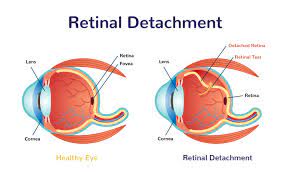 Tiny spots or wavy lines that drift across your field of view. Retinal Detachment Warning Signs Treatment