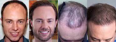 Our cape cod, ma office is known throughout the region as an. Hair Restoration Before After Images
