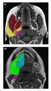 Figure 1 From Infections Of The Deep Neck Spaces Semantic Scholar