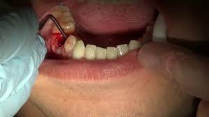 Baby Tooth Removal In Adult Youtube