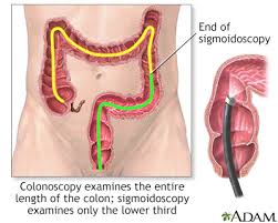 Get the facts on colon cancer (colorectal cancer) signs, symptoms, causes, prognosis, treatment information, and prevention screening through colonoscopy. Colon Cancer Information Mount Sinai New York