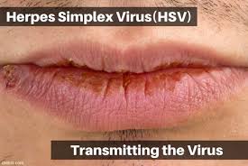 herpes simplex virus hsv