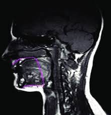 sagittal t1 mri of normal cavity