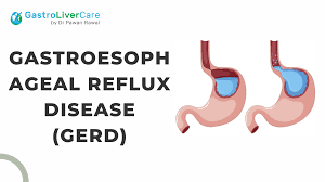 best gastroesophageal reflux disease