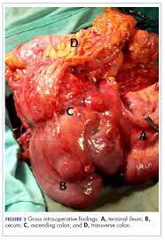 carcinoma of the colon in a child