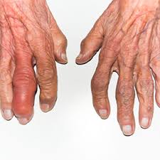 Image result for rheumatoid arthritis