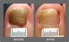 toenail fungus laser treatment boca