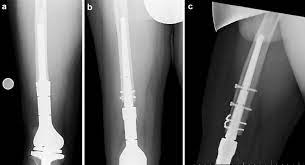 a distal femur replacement with pre