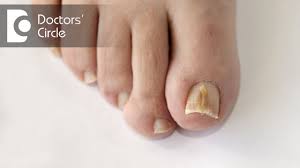 causes of vertical dark line on big toe