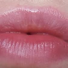 white dots on my lips after lip fillers