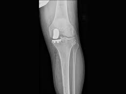 Learn about mri anatomy with free interactive flashcards. What Is A Partial Knee Replacement