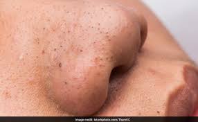 Hydrafacials use water pressure to open up your pores and remove dead skin cells and debris. How To Remove Blackheads From Nose 5 Natural Masks And Scrubs Ndtv Food