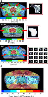 proton beam therapy and localised