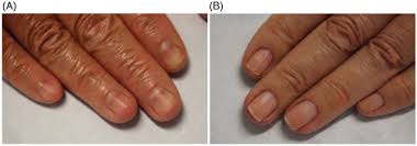 brittle nail syndrome