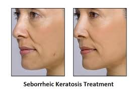 seborrheic keratosis treatment market