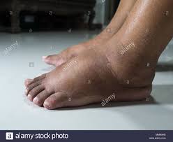 Image result for black man horrible feet