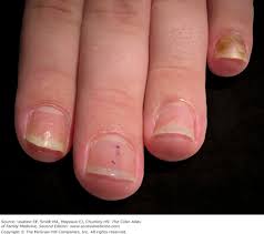 psoriatic nails basiccal key