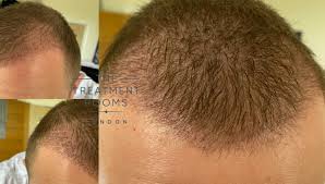 hair transplant timeline what to