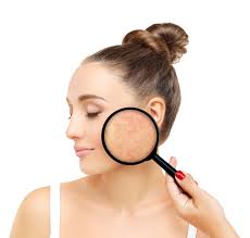 acne scars acne scar removal