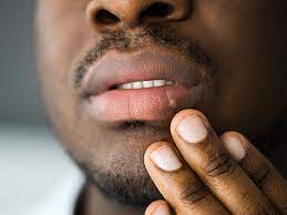 stds symptoms treatment and more