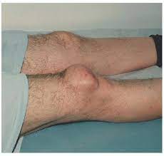 prepatellar bursitis housemaid s knee