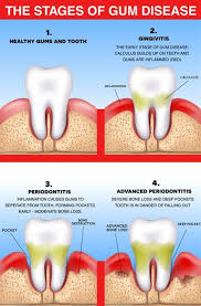 how to keep gums healthy with care