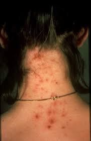 Head Lice Infestation Wikipedia