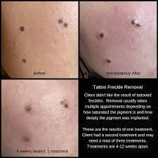 tattoo removal and lightening about