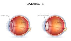 cataract surgery diagnosis treatment