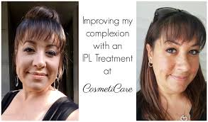 ipl treatment at cosmeticare