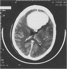We sought to confirm the existence of abulia as an entity recognized by clinicians, to generate a set of items character … Frontal Lobe Tumor Patient 1 Had Abulia Due To A Benign Meningioma A Download Scientific Diagram