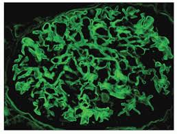 Anti Glomerular Basement Membrane